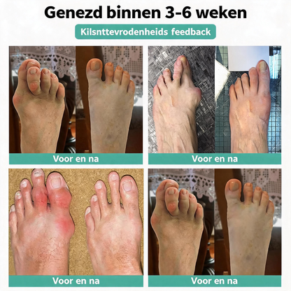 🏅Natravor® Relief Botanical Bunion Comfort Patcht👠💃（Physical Stretch Support + Botanical Comfort Formula)